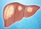 Liver Cancer the Fastest-Growing Cause of Cancer Deaths in United States Liver Cancer the Fastest-Growing Cause of Cancer Deaths in United States