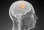 Radiosurgery and Careful Monitoring Combo Recommended for Newly Diagnosed Brain Metastases Radiosurgery and Careful Monitoring Combo Recommended for Newly Diagnosed Brain Metastases