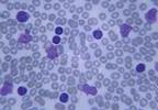 Venetoclax Induces Deep Remissions in Ultra-High Risk Relapsed/Refractory CLL with 17p Deletion Venetoclax Induces Deep Remissions in Ultra-High Risk Relapsed/Refractory CLL with 17p Deletion