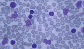 acute lymphoblastic leukemia acute lymphoblastic leukemia