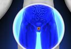 ASCO, Cancer Care Ontario Update Recommendations on Brachytherapy in Prostate Cancer ASCO, Cancer Care Ontario Update Recommendations on Brachytherapy in Prostate Cancer