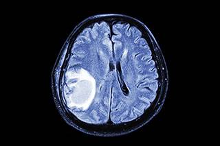 Brain mets Brain mets