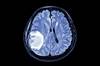 Brain mets: Time for a new approach Brain mets: Time for a new approach