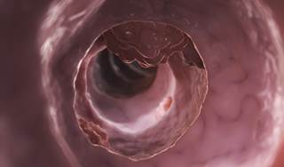 Cimetidine may improve survival in colorectal cancer Cimetidine may improve survival in colorectal cancer