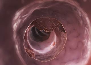 Increased selenium levels associated with reduced risk of colorectal cancer Increased selenium levels associated with reduced risk of colorectal cancer