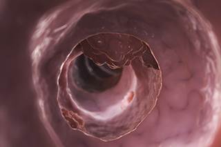 Among colorectal cancer survivors, physical activity positively associated with quality of life Among colorectal cancer survivors, physical activity positively associated with quality of life