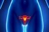 Cancer-killing virus and doxorubicin act synergistically on metastatic ovarian cancer Cancer-killing virus and doxorubicin act synergistically on metastatic ovarian cancer