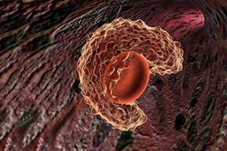 Study researchers randomly assigned patients with untreated metastatic triple-negative breast cancer to receive either atezolizumab plus nab-paclitaxel or placebo plus nab-paclitaxel in a 1:1 ratio. Study researchers randomly assigned patients with untreated metastatic triple-negative breast cancer to receive either atezolizumab plus nab-paclitaxel or placebo plus nab-paclitaxel in a 1:1 ratio.