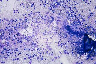 PRM-151 therapy well tolerated by patients with advanced myelofibrosis PRM-151 therapy well tolerated by patients with advanced myelofibrosis