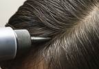 Hair, Nail Abnormalities Common With Ibrutinib Therapy Hair, Nail Abnormalities Common With Ibrutinib Therapy