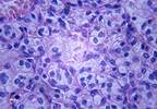 Pembrolizumab and Ipilimumab Combo Safe for Melanoma and Renal Cell Carcinoma Pembrolizumab and Ipilimumab Combo Safe for Melanoma and Renal Cell Carcinoma