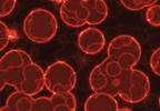 Unexplained Leukocytosis, Thrombocytosis in MPN Warrants Evaluation for CML Unexplained Leukocytosis, Thrombocytosis in MPN Warrants Evaluation for CML