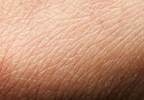 Atopic Dermatitis Linked to Increased Risk of Skin Cancer Atopic Dermatitis Linked to Increased Risk of Skin Cancer
