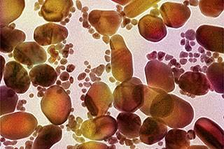 Study finds $1 test using gold nanoparticles outperforms PSA screen for prostate cancer Study finds $1 test using gold nanoparticles outperforms PSA screen for prostate cancer