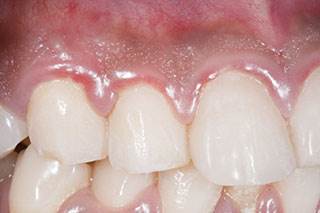 Treating periodontal disease may reduce prostate inflammation Treating periodontal disease may reduce prostate inflammation