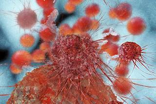Statin drugs deny prostate cancer cells access to needed hormones, delaying disease progression Statin drugs deny prostate cancer cells access to needed hormones, delaying disease progression