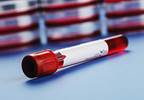 Liquid biopsy: A new tool in the management of NSCLC Liquid biopsy: A new tool in the management of NSCLC