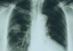 New Study Questions Standard Dosage for Treating Metastatic Non-Small Cell Lung Cancer New Study Questions Standard Dosage for Treating Metastatic Non-Small Cell Lung Cancer
