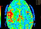 History of Headache, Vomiting, Seizures Associated With Pediatric Brain Cancer History of Headache, Vomiting, Seizures Associated With Pediatric Brain Cancer