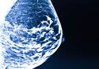 Letrozole Significantly Reduces Late Invasive Events in HR+ Early Breast Cancer Letrozole Significantly Reduces Late Invasive Events in HR+ Early Breast Cancer