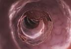 Higher Vitamin D Concentrations Associated with Improved Survival in mCRC Higher Vitamin D Concentrations Associated with Improved Survival in mCRC