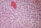 RFA Plus Chemo Associated with Improved Survival in Unresectable Colorectal CA Liver Metastases RFA Plus Chemo Associated with Improved Survival in Unresectable Colorectal CA Liver Metastases