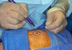 Narrow Excision Margins in High Risk Primary Melanoma Associated with Higher Cancer-Related Death Narrow Excision Margins in High Risk Primary Melanoma Associated with Higher Cancer-Related Death