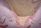 Managing capecitabine-associated mucositis Managing capecitabine-associated mucositis