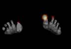 Injury to the big toe leads to an unexpected lymphoma Injury to the big toe leads to an unexpected lymphoma