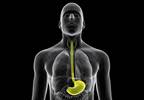 Evolutionary Theory Predicts Progression of Barrett's Esophagus to Esophageal Adenocarcinoma Evolutionary Theory Predicts Progression of Barrett's Esophagus to Esophageal Adenocarcinoma