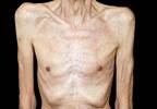 Breakthrough supportive care: Overcoming cancer anorexia/cachexia Breakthrough supportive care: Overcoming cancer anorexia/cachexia