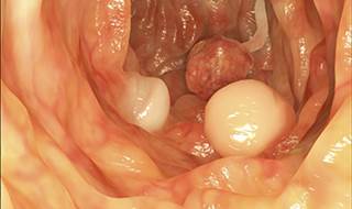 Colorectal cancer is diagnosed in younger persons in a significantly higher proportion of minority groups in the United States. Colorectal cancer is diagnosed in younger persons in a significantly higher proportion of minority groups in the United States.