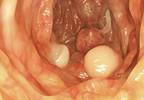 MSTF Releases Updated Recommendations for Colorectal Cancer Screening MSTF Releases Updated Recommendations for Colorectal Cancer Screening