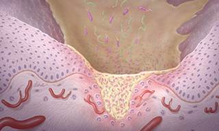 In a phase 2 study, researchers sought to determine the effectiveness of adding HMB/Arg/Gln to cisplatin-based chemoradiotherapy for patients with head and cancers to prevent CRT-induced oral mucositi In a phase 2 study, researchers sought to determine the effectiveness of adding HMB/Arg/Gln to cisplatin-based chemoradiotherapy for patients with head and cancers to prevent CRT-induced oral mucositi
