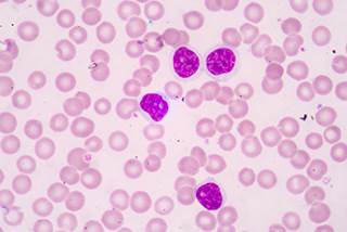 Economic Evaluation of Obinutuzumab in Combination With Chlorambucil in First-line Treatment of Patients With Chronic Lymphocytic Leukemia in Spain Economic Evaluation of Obinutuzumab in Combination With Chlorambucil in First-line Treatment of Patients With Chronic Lymphocytic Leukemia in Spain
