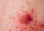 Topical Skin Creams Are Effective in Treatment of Superficial Basal Cell Carcinoma Topical Skin Creams Are Effective in Treatment of Superficial Basal Cell Carcinoma