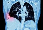 In NSCLC, Brain Metastases Not Associated With Worse Survival In NSCLC, Brain Metastases Not Associated With Worse Survival