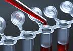 Blood Sample Offers a New Way of Detecting Cancer Blood Sample Offers a New Way of Detecting Cancer