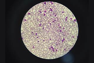Secondary cancers occurred in 5.6% of the 9,200 adult patients with CML included in this study. Secondary cancers occurred in 5.6% of the 9,200 adult patients with CML included in this study.