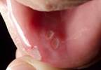 Study Evaluates Effect of Everolimus-induced Stomatitis Study Evaluates Effect of Everolimus-induced Stomatitis
