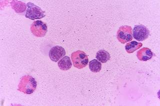 Obinutuzumab led to increased activation of FcγRIIIa and FcγRI compared with rituximab or ofatumumab, researchers found. Obinutuzumab led to increased activation of FcγRIIIa and FcγRI compared with rituximab or ofatumumab, researchers found.