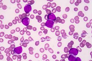 Results from the TOWER trial demonstrate that blinatumomab (Blincyto) effectively improved OS in high-risk B-cell precursor ALL. Results from the TOWER trial demonstrate that blinatumomab (Blincyto) effectively improved OS in high-risk B-cell precursor ALL.