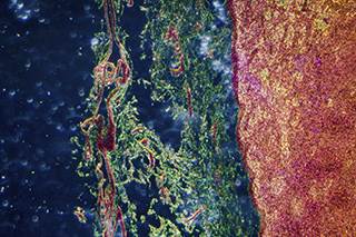aHSCT Should Be Standard of Care for HIV-Related Lymphoma aHSCT Should Be Standard of Care for HIV-Related Lymphoma