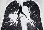 Inconclusive: The Pulmonary Nodules You Need to Follow Inconclusive: The Pulmonary Nodules You Need to Follow