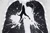 Inconclusive: The Pulmonary Nodules You Need to Follow Inconclusive: The Pulmonary Nodules You Need to Follow