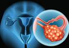 Niraparib Maintains Quality of Life in Recurrent Ovarian Cancer Niraparib Maintains Quality of Life in Recurrent Ovarian Cancer