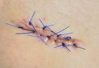 Few Patients Wish to Receive Skin Cancer Biopsy Results in Person Few Patients Wish to Receive Skin Cancer Biopsy Results in Person