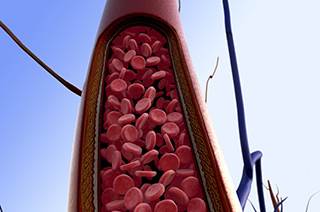 Risk of Arterial Thromboembolism Greater With First-Time Cancer Risk of Arterial Thromboembolism Greater With First-Time Cancer