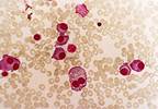 Triplet Regimen Found Most Effective for Relapsed/Refractory Multiple Myeloma Triplet Regimen Found Most Effective for Relapsed/Refractory Multiple Myeloma