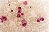 Triplet Regimen Found Most Effective for Relapsed/Refractory Multiple Myeloma Triplet Regimen Found Most Effective for Relapsed/Refractory Multiple Myeloma